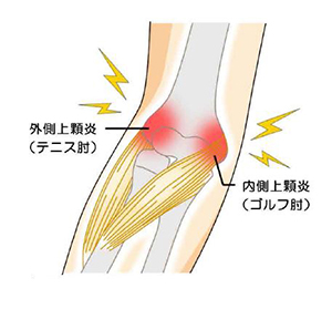 テニス肘・ゴルフ肘