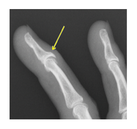 ヘバーデン結節