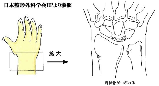キーンベック病