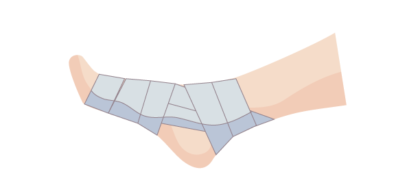 RICE処置（圧迫）