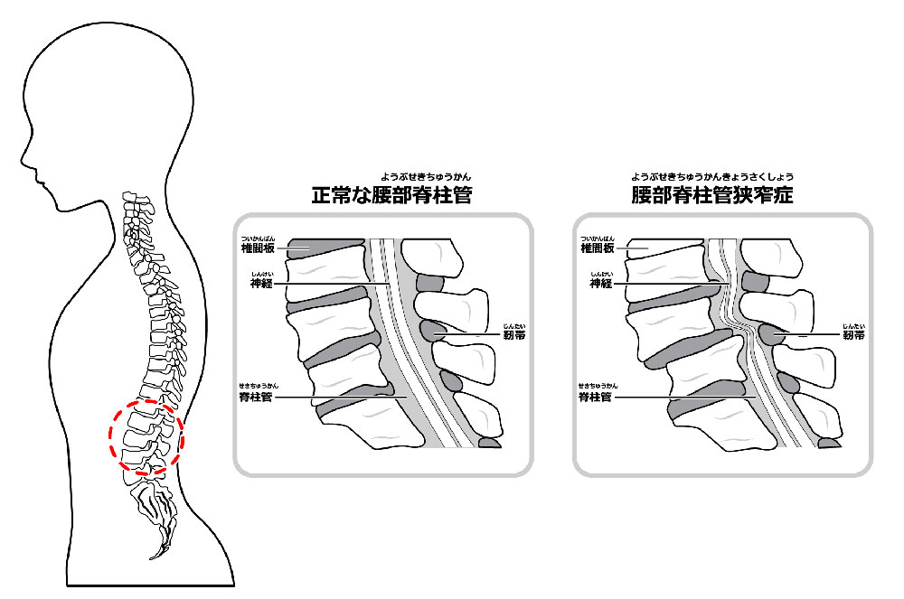 腰部脊柱管狭窄症