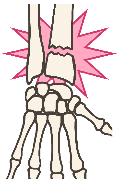 橈骨遠位端骨折